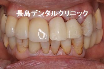 上顎前歯部2歯欠損に対して1本のインプラントで2歯を支えるカンチレバーで対応した症例