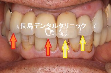 上顎前歯部2歯欠損に対して1本のインプラントで2歯を支えるカンチレバーで対応した症例