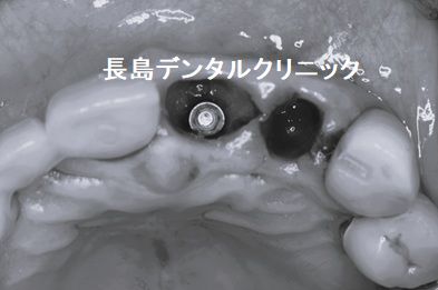 上顎前歯部2歯欠損に対して1本のインプラントで2歯を支えるカンチレバーで対応した症例