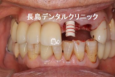 上顎前歯部2歯欠損に対して1本のインプラントで2歯を支えるカンチレバーで対応した症例