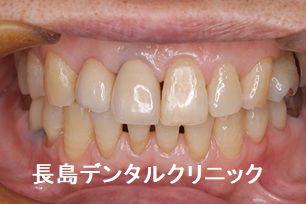 上顎前歯2歯欠損に対して1本のインプラントで対応したカンチレバー症例