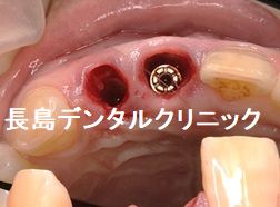 上顎前歯2歯欠損に対して1本のインプラントで対応したカンチレバー症例