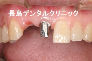 上顎前歯2歯欠損に対して1本のインプラントで対応したカンチレバー症例