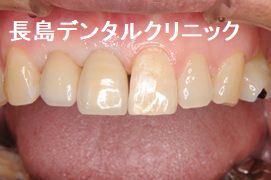 上顎前歯2歯欠損に対して1本のインプラントで対応したカンチレバー症例