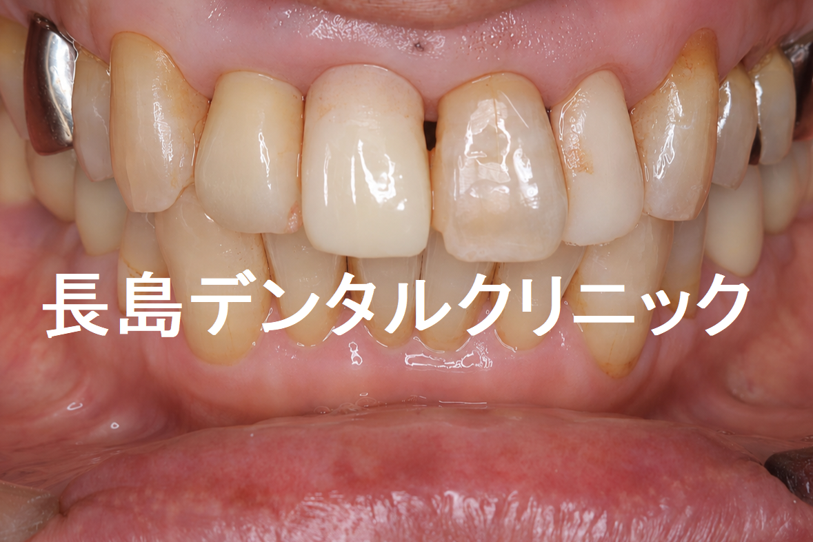 上顎2本のインプラントを1歯挟んで埋入した症例