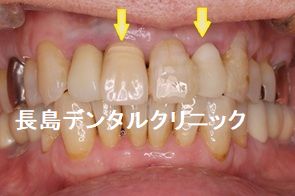 上顎2本のインプラントを1歯挟んで埋入した症例