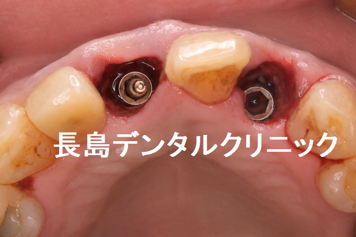 上顎2本のインプラントを1歯挟んで埋入した症例