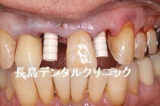 上顎2本のインプラントを1歯挟んで埋入した症例
