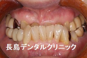 反対咬合の患者様に右下奥歯にインプラントブリッジを装着した症例