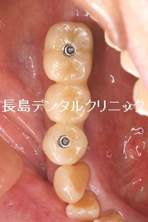 反対咬合の患者様に右下奥歯にインプラントブリッジを装着した症例
