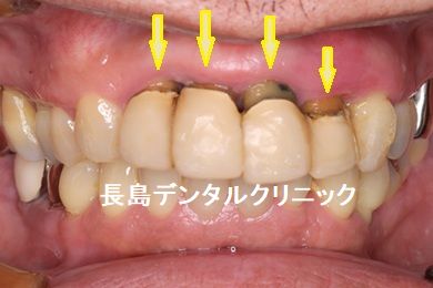 歯周病で抜歯した上顎前歯4本にインプラント2本を使いインプラントブリッジを装着した症例