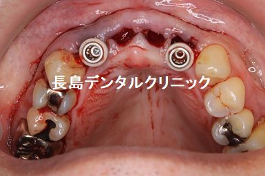 歯周病で抜歯した上顎前歯4本にインプラント2本を使いインプラントブリッジを装着した症例