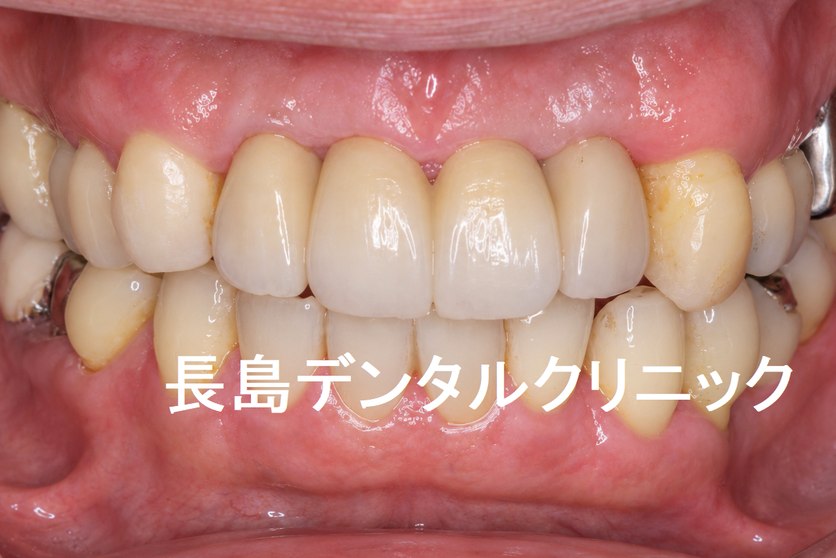 歯周病で抜歯した上顎前歯4本にインプラント2本を使いインプラントブリッジを装着した症例