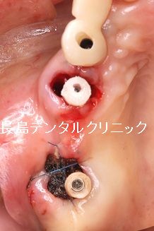 右上奥歯のブリッジを支える2本の歯を抜歯した後2本のインプラントを埋入しプロビを装着した症例