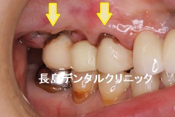 右上奥歯のブリッジを支える2本の歯を抜歯した後2本のインプラントを埋入しプロビを装着した症例