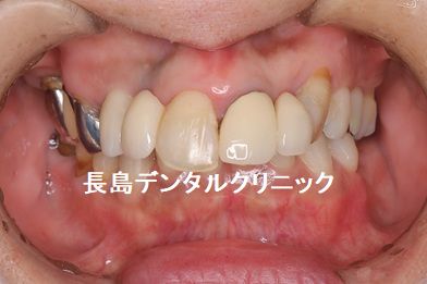 右上奥歯のブリッジを支える2本の歯を抜歯した後2本のインプラントを埋入しプロビを装着した症例