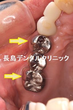 右上奥歯のブリッジを支える2本の歯を抜歯した後2本のインプラントを埋入しプロビを装着した症例