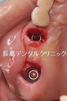 右上奥歯のブリッジを支える2本の歯を抜歯した後2本のインプラントを埋入しプロビを装着した症例
