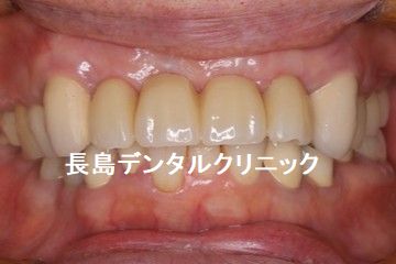 上顎4歯つながったブリッジをはずし2本のインプラントを使いブリッジを作り直した症例