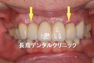 上顎4歯つながったブリッジをはずし2本のインプラントを使いブリッジを作り直した症例