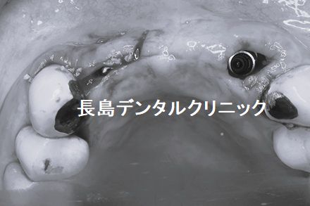 上顎4歯つながったブリッジをはずし2本のインプラントを使いブリッジを作り直した症例