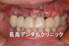 上顎4歯つながったブリッジをはずし2本のインプラントを使いブリッジを作り直した症例
