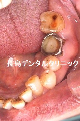 上下大臼歯部に幅が6~8mmnのエクストラワイドのショートインプラントを使う理由とは?