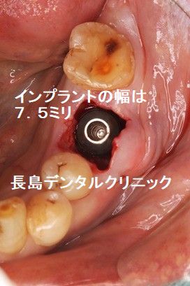 上下大臼歯部に幅が6~8mmnのエクストラワイドのショートインプラントを使う理由とは?