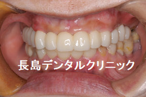 ジルコニアで製作したインプラントブリッジの破折を防ぐ方法とは