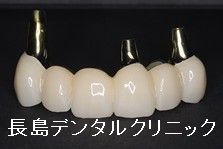 ジルコニアで製作したインプラントブリッジの破折を防ぐ方法とは