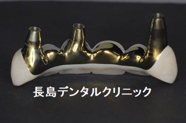 ジルコニアで製作したインプラントブリッジの破折を防ぐ方法とは