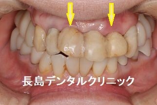 上顎前歯のインプラント 即時荷重で治療期間中の審美を改善した症例