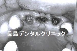 上顎前歯のインプラント 即時荷重で治療期間中の審美を改善した症例
