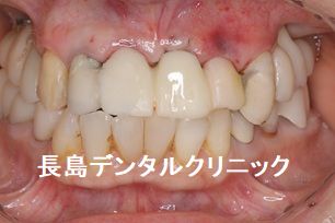 上顎前歯のインプラント 即時荷重で治療期間中の審美を改善した症例