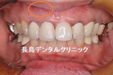 上顎前歯の根の先にできた大きな膿を頬側の歯肉を切開し除去しながらインプラント埋入を行った症例