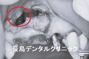 上顎前歯の根の先にできた大きな膿を頬側の歯肉を切開し除去しながらインプラント埋入を行った症例