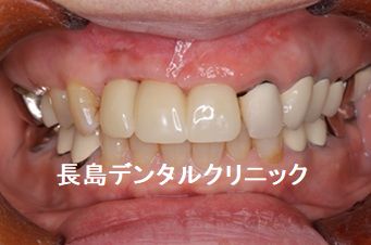 上顎前歯の根の先にできた大きな膿を頬側の歯肉を切開し除去しながらインプラント埋入を行った症例