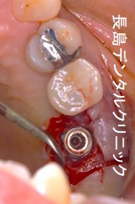 左上奥歯2本欠損に対して、右上反対側の歯数に合わせて1本インプラントを埋入した症例