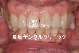 左上奥歯2本欠損に対して、右上反対側の歯数に合わせて1本インプラントを埋入した症例