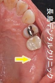 左上奥歯2本欠損に対して、右上反対側の歯数に合わせて1本インプラントを埋入した症例