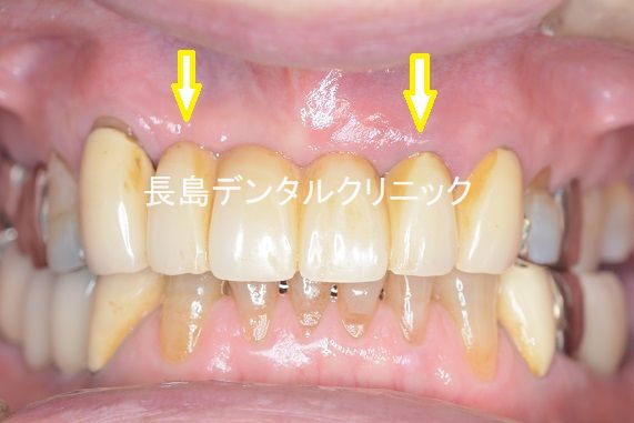 上の前歯4本欠損を２本インプラントを入れてブリッジで治療した症例 横須賀市のhaインプラント治療