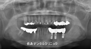 左下義歯が合わないのでインプラントに変更した症例