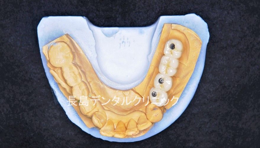 左下義歯が合わないのでインプラントに変更した症例