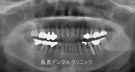 左下の1本義歯がうまく噛めないのでインプラントで治療した症例