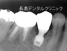 外れたさし歯が虫歯でインプラントで治療した症例