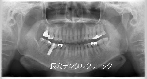 他院で治療中の歯を抜歯しインプラントを埋入した症例