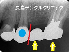 上の奥歯のブリッジが使えなくなりインプラントを埋入した症例