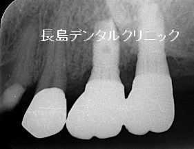 上の奥歯のブリッジが使えなくなりインプラントを埋入した症例