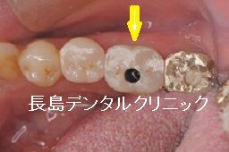 歯茎を切らないフラップレスで左下奥歯にインプラント1本埋入