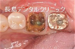 歯茎を切らないフラップレスで左下奥歯にインプラント1本埋入